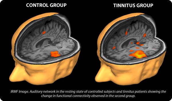 Tinnitus scan